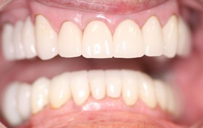 Close up of white, healthy teeth showing upper and lower dental arches in open mouth position.