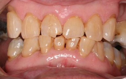 Close up of discolored, stained teeth showing dental condition requiring professional treatment.