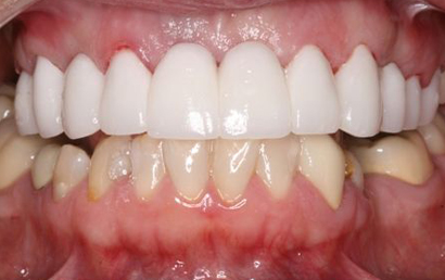 Close up of dental work showing white upper teeth veneers and natural lower teeth comparison.