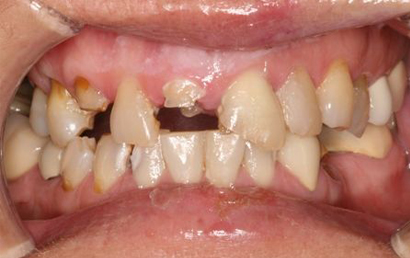 Close up of severely decayed teeth with visible gaps and discoloration, showing dental disease requiring professional treatment.