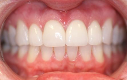 Close up view of healthy white teeth and pink gums in an open mouth smile.