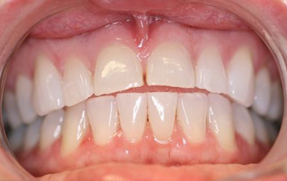 Close up intraoral view of upper and lower teeth showing dental alignment and oral health condition.