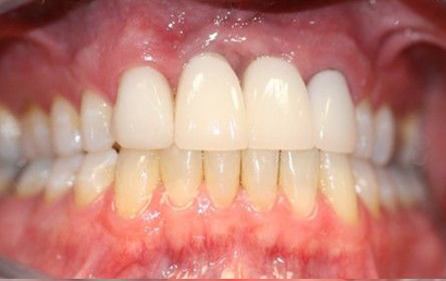 Close up view of natural-looking dental implants and veneers showing aligned upper and lower teeth with healthy gum tissue.