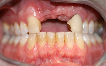 Open mouth showing upper and lower teeth with visible gaps and dental alignment issues.