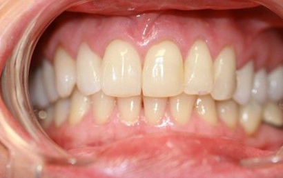 Close up view of healthy white teeth and pink gums in open mouth dental examination.