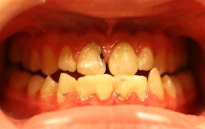 Close up view of teeth with visible decay, discoloration, and poor dental health condition.