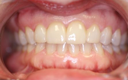 Close up of upper and lower teeth showing dental alignment and bite relationship in clinical setting.