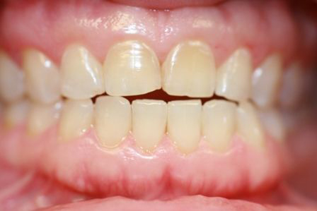 Close up view of aligned upper and lower teeth showing natural dental appearance and healthy gums.