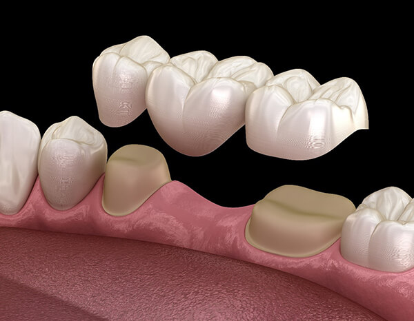 3D dental implant illustration showing ceramic crowns on pink gum model against black background.