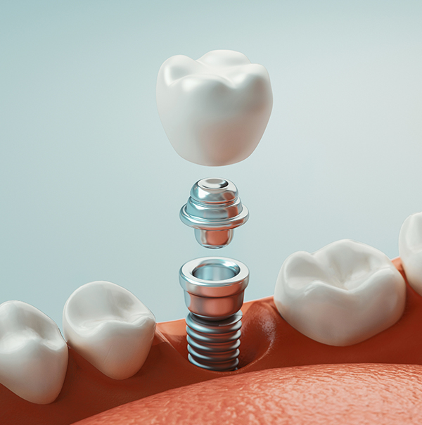 Dental Implants hattiesburg | Dental Implants columbia | ms