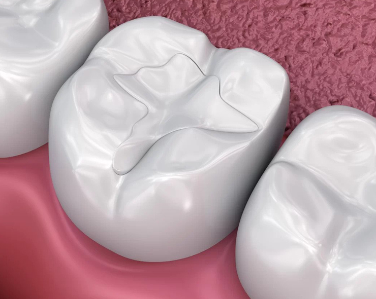 3D dental implant models displayed on pink gum tissue background for cosmetic dentistry demonstration.
